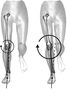 spostamento della asse AAII/ginocchio