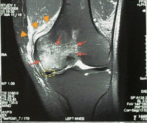 artrite ginocchio